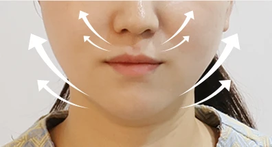 스몰핏 주사 후 · 얼굴 라인 개선